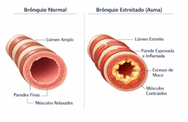Asma bronquica e homeopatia