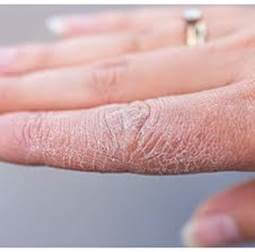 dermatite atopica tratamento natural